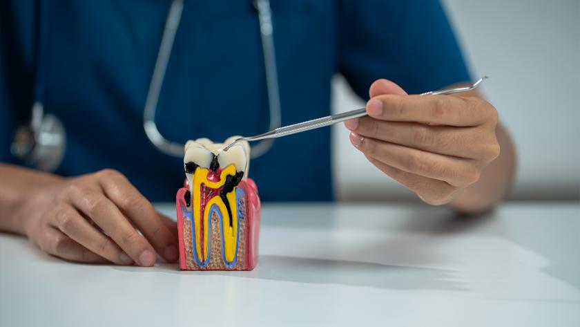 Root-Canal-Treatment