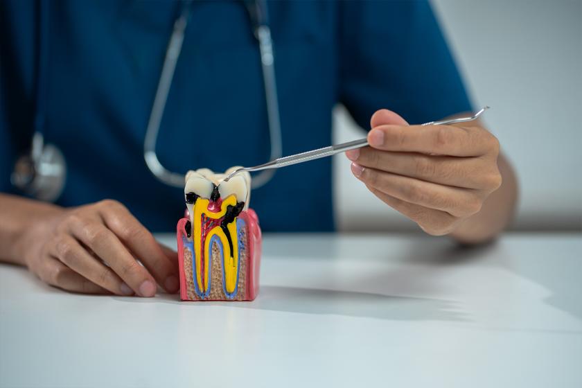Root-Canal-Treatment