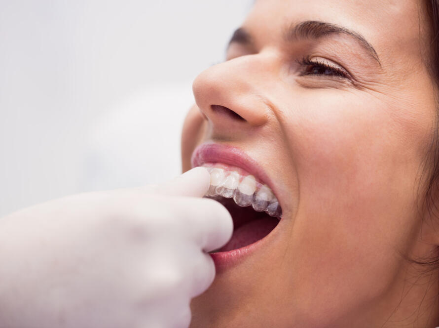 Cleaning Your Invisalign Aligners